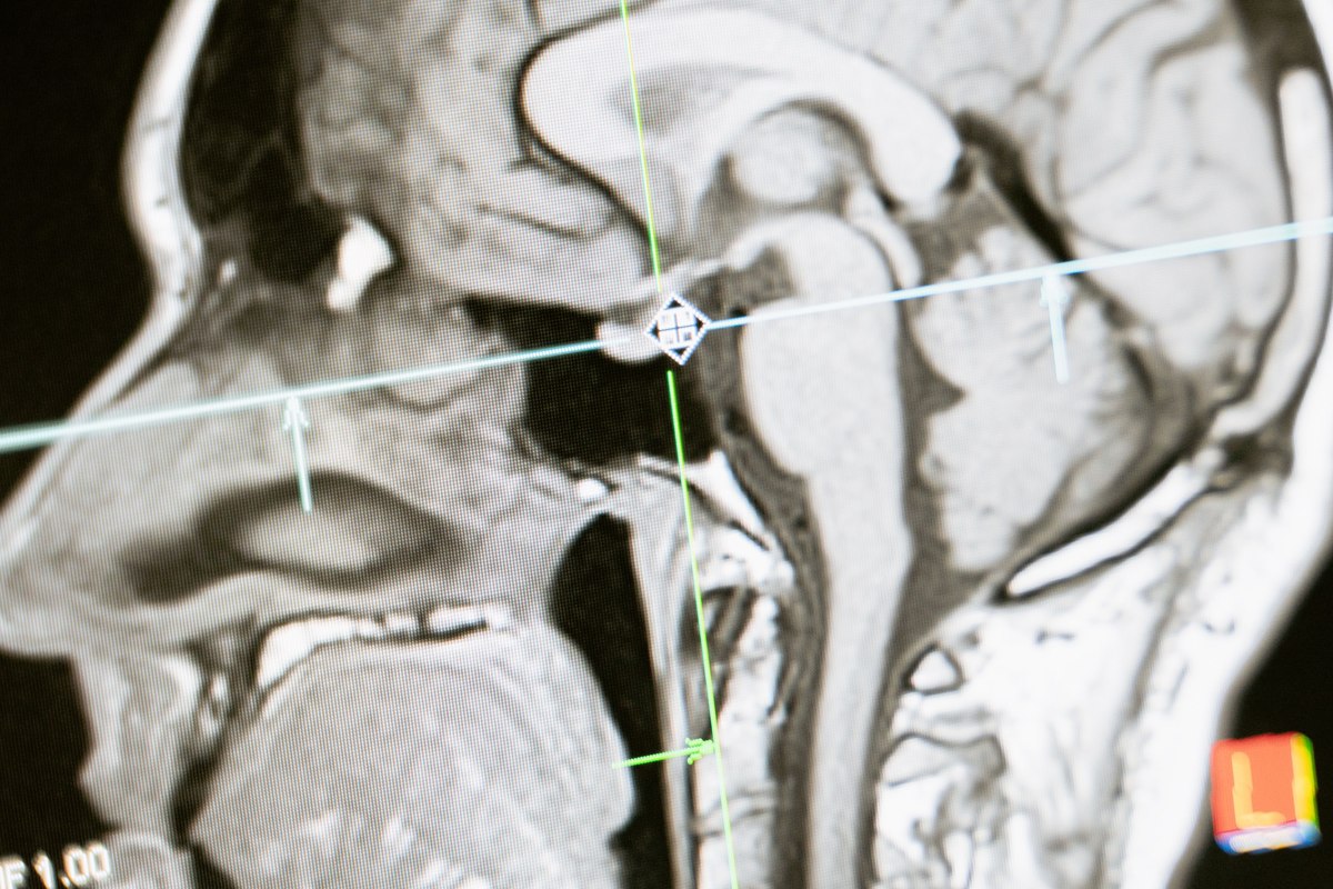Resonancia magnética del cráneo humano en vista lateral, mostrada en un monitor con líneas y flechas de referencia para medir estructuras cerebrales.